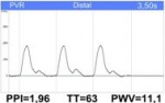 VICORDER®: Pulswellengeschwindigkeit (PWV)